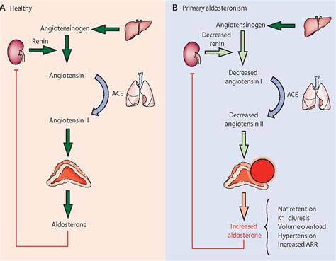 Diagnosis and treatment of primary aldosteronism - The Lancet Diabetes ...