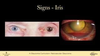 Neovascular glaucoma - Optician Certification