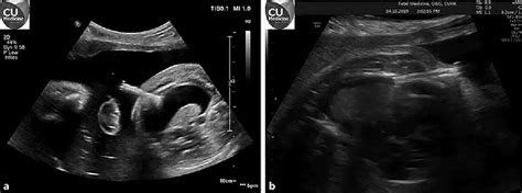 Figure 2 from The Use of Somatex Shunt for Fetal Pleural Effusion: A ...