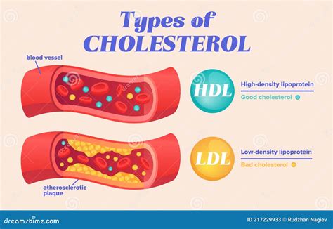 Cholesterol Types Comparison With HDL And LDL Lipoprotein Vector ...