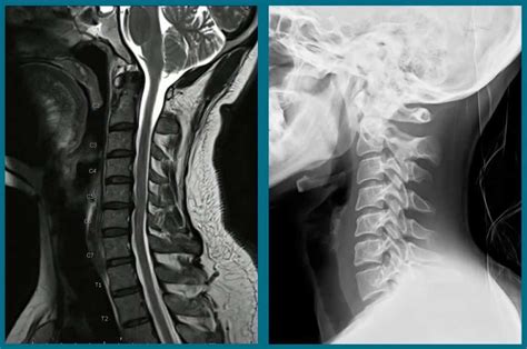 Neck MRI And X-Ray | Health 1st Wellness & Physical Medicine