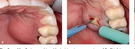 [PDF] The acute apical abscess: Aetiology, microbiology, treatment and ...