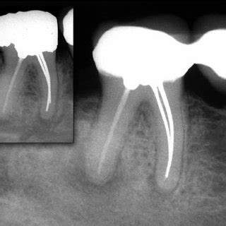 Apical periodontitis may continue for many years without symptoms. Main ...