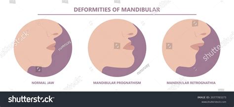 21 Micrognathia Images, Stock Photos & Vectors | Shutterstock