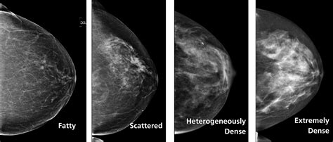 Breast Cancer Mammogram