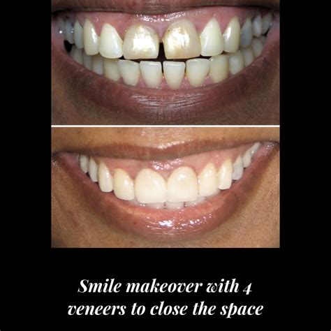 Veneers | New York Cosmetic Dentist