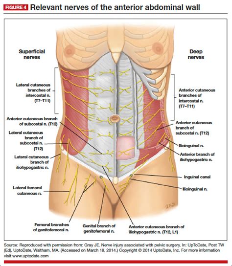 Iliohypogastric Nerve Pain