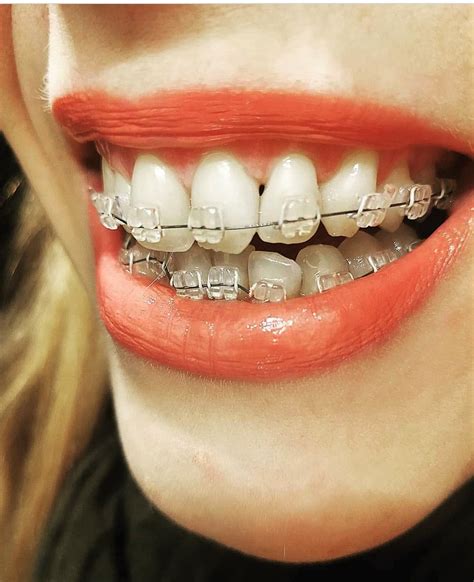 clear braces with coloured bands - Exorbitant Blook Pictures Library