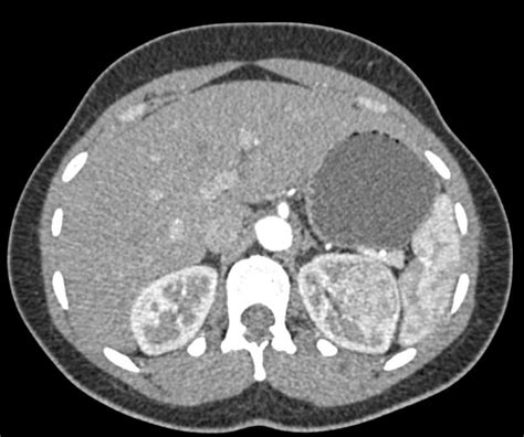 Oncocytoma Left Kidney - Kidney Case Studies - CTisus CT Scanning