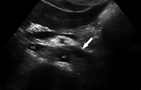 Retroaortic Left Renal Vein - JoAnn Aichroth, Traci Fox, 2013