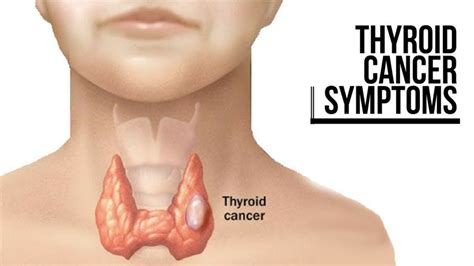 Thyroid Cancer: Symptoms, Types, Causes And Treatment Overview