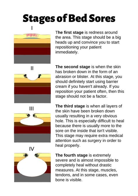 "Stages of Bed Sores Chart" Poster for Sale by Caregiverology | Bed ...