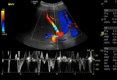 [Figure, Hepatic venous doppler ultrasound showing aliasing artifact ...