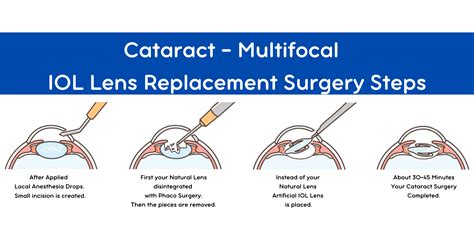 Multifocal Cataract Surgery- Akıllı Lazer Göz Merkezi