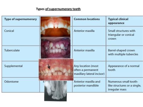 Local Factors_Etiology of Malocclusion - Dr. Nabil Al-Zubair