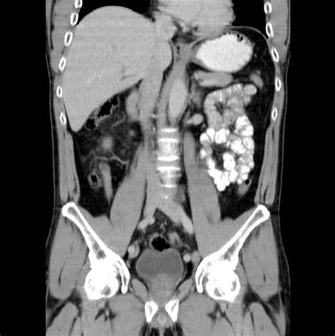 What Is A Ct Scan With Contrast Of The Abdomen