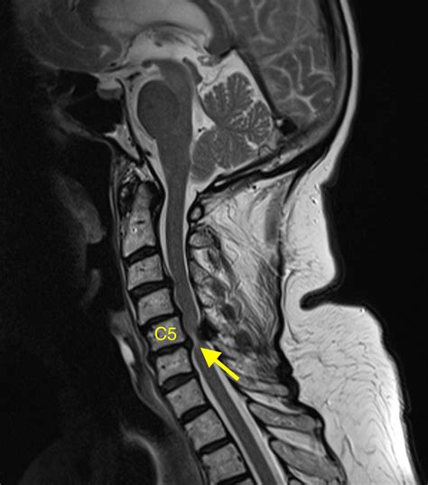 Cervical Spondylosis Mri | Hot Sex Picture