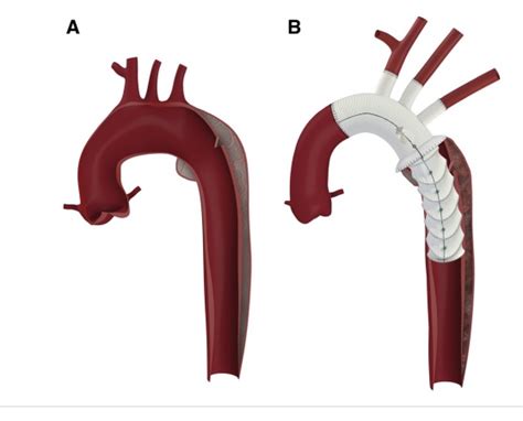 FROZEN ELEPHANT TRUNK (FET) PROCEDURE IN A 52 YEARS OLD CHRONIC AORTIC ...