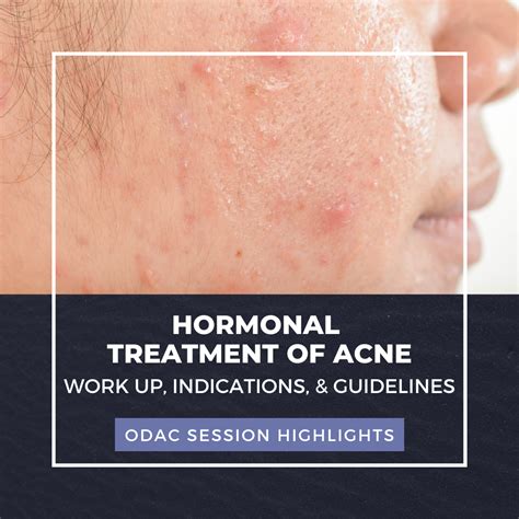 Hormonal Treatment of Acne: Work up, Indications, & Guidelines - Next ...