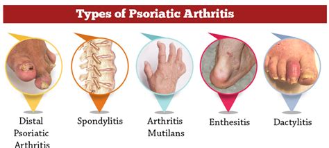 Psoriatic Arthritis Treatment