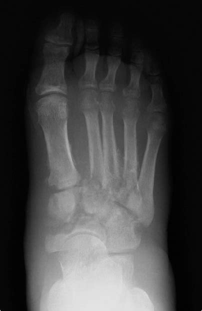 Figure 1 from Diagnosis and treatment of Charcot arthropathy in ...