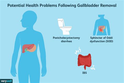 Gallbladder Pain Location Diagram - exatin.info