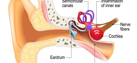 Labyrinthitis – Causes, Symptoms and Treatment – Healthy Food Near Me