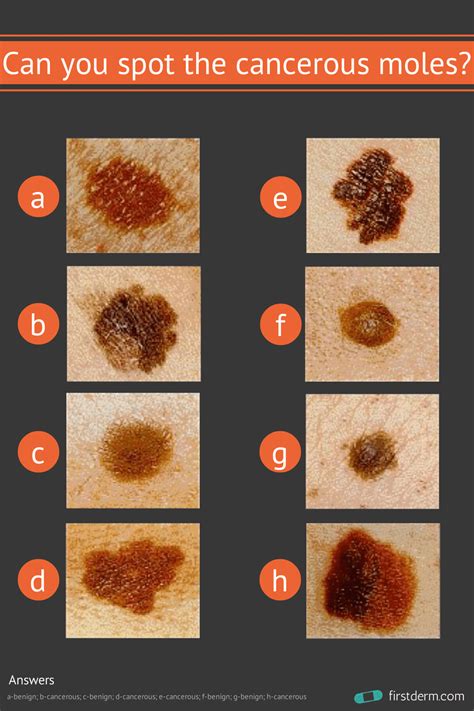 Cancerous Moles Vs Normal Moles