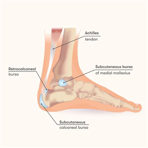 Retrocalcaneal Bursitis: Causes, Symptoms & Treatment