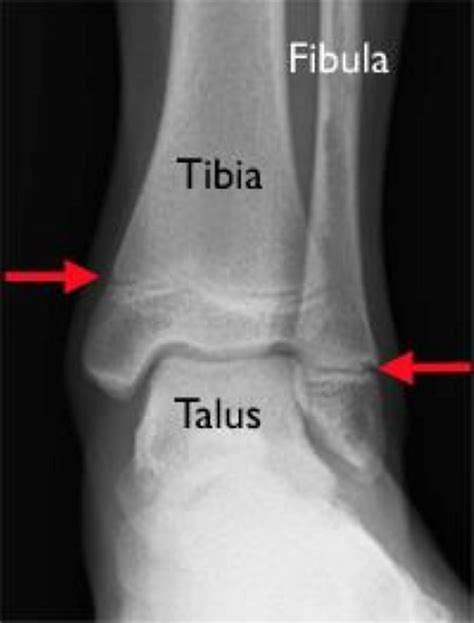 Triplane fracture causes, symptoms, diagnosis & treatment