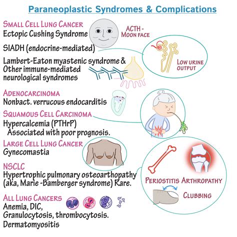 Paraneoplastic syndromes associated with Lung carcinomas. - MEDizzy