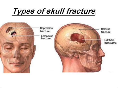 Fractured Skull - Fracture Treatment