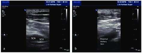 Ultrasound of the Subclavian Vein in the infraclavicular approach: a ...