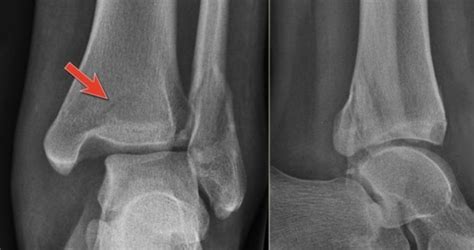 발목 골절(Fracture of ankle) : 발목이 비틀리면서 발목 뼈가 부러졌어요 : 네이버 블로그