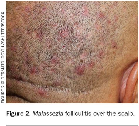 Folliculitis Scalp