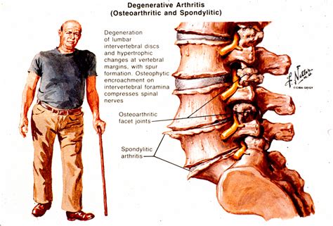 Arthritis of The Spine | Arthritis In Back Symptoms