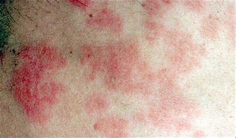 Sun Poisoning Rash – Pictures, Symptoms, Causes and Treatment