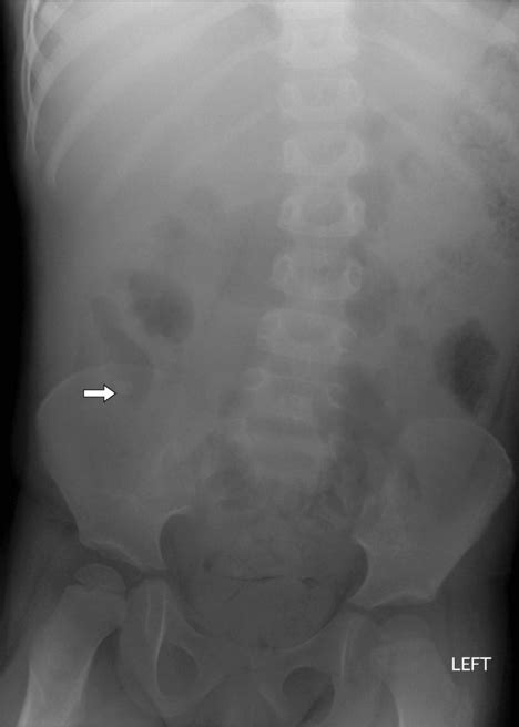 Appendicitis | Radiology Key