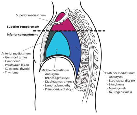 [Figure, Mediastinum Anatomy. Anatomy includes superior ...