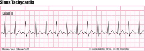 ECG Educator Blog : Sinus Tachycardia