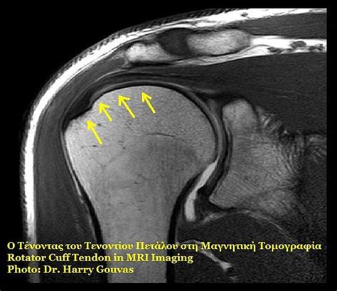 Rotator Cuff Tear — Surgical Treatment | Online Medical Library