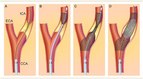 Figure 3 from Carotid artery stenting vs. endarterectomy. | Semantic ...