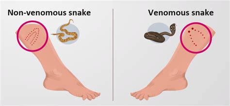 What difference can be observed between the bite of venomous and non ...