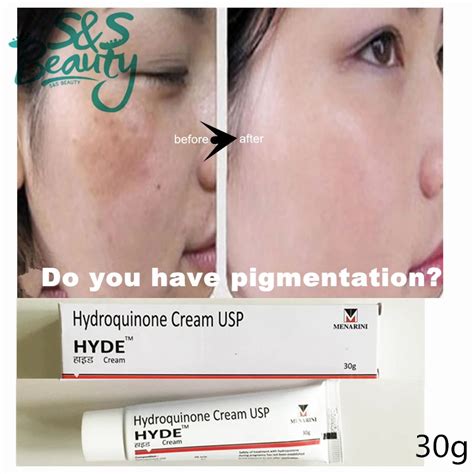 hydroquinone cream 3% whitening skin pigment spots acne scars ...