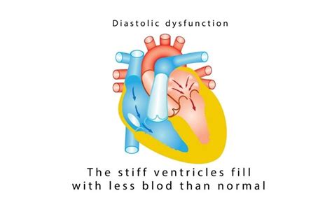 Symptoms Of Diastolic Heart Failure