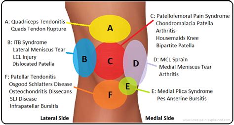 TKR - Pain in the replaced knee | Joint Replacement Patient Forum