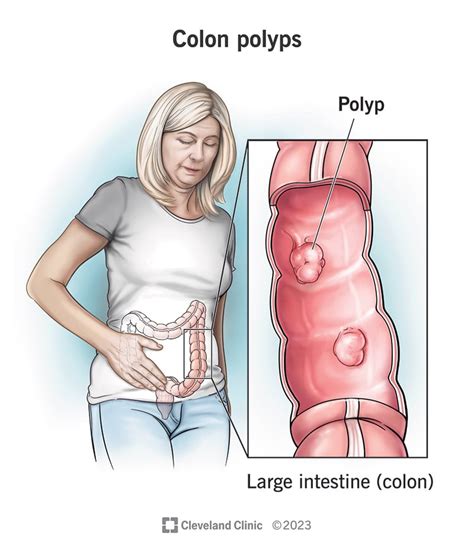 Rectal Polyp Symptoms