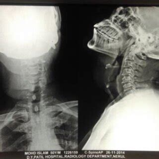 X-ray neck of the patient. | Download Scientific Diagram