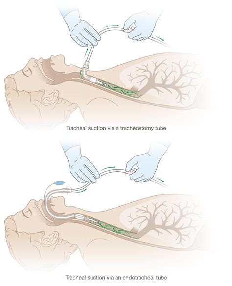 Tracheostomy Tube Suctioning