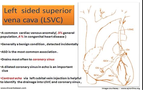 unroofed coronary sinus | Dr.S.Venkatesan MD